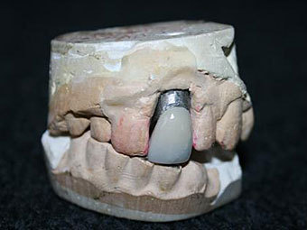 Гипсовая модель зубов Элвиса Пресли будет выставлена на аукционе
